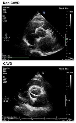 Decreased Glucagon-Like Peptide-1 Is Associated With Calcific Aortic Valve Disease: GLP-1 Suppresses the Calcification of Aortic Valve Interstitial Cells